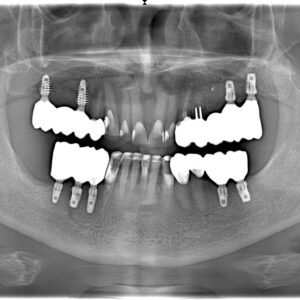 Assessment of the state of the parodontal tissues of the teeth intermediate with the lateral defect of the dentition when they are replaced by different constructions